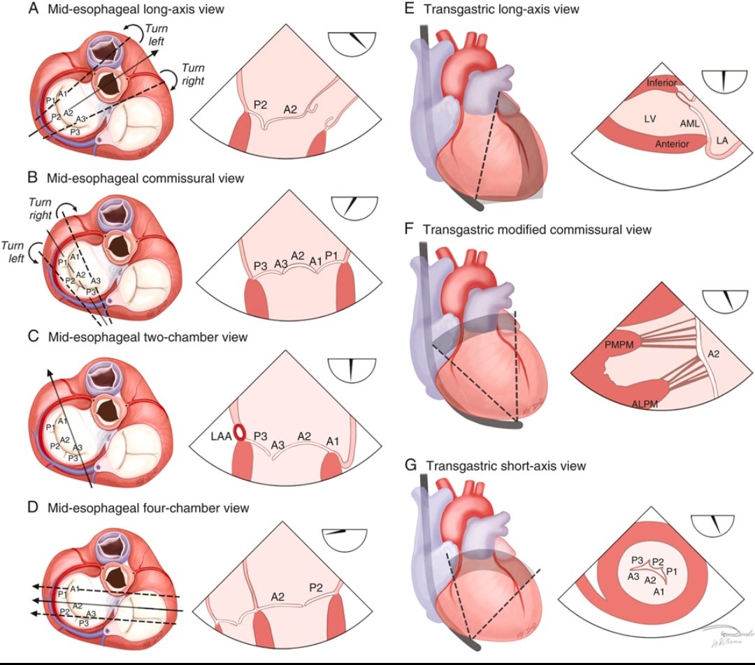 Standard 2D transesophageal views for assessing the mitral valve.