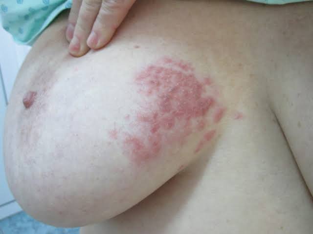 Herpes Zoster (Shingles).
