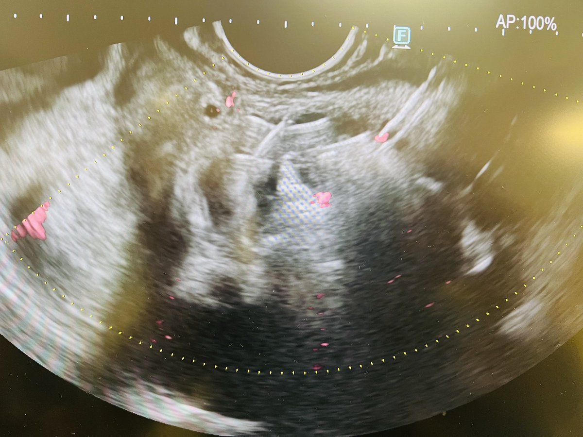 Kudos to our team <a href="/helpatologist/">Nadeem Tehami</a> <a href="/Marktheliverdoc/">Professor Mark Wright</a> #JoeCoad on an outstanding live demo of complex endohepatology cases including GV coiling, EUS-PPG, and liver biopsy. All performed with remarkable skill and composure. 

🎊 Congrats to <a href="/smkahlon/">Sajjad Mahmood</a> #MAES2025 for a fantastic meeting!