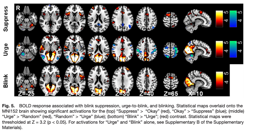 ImagingNeurosci's tweet image. New paper in Imaging Neuroscience by Mairi S. Houlgreave, Stephen Jackson, et al:
Uncovering the neural correlates of the urge-to- blink: A study utilising subjective urge ratings and paradigm free mapping