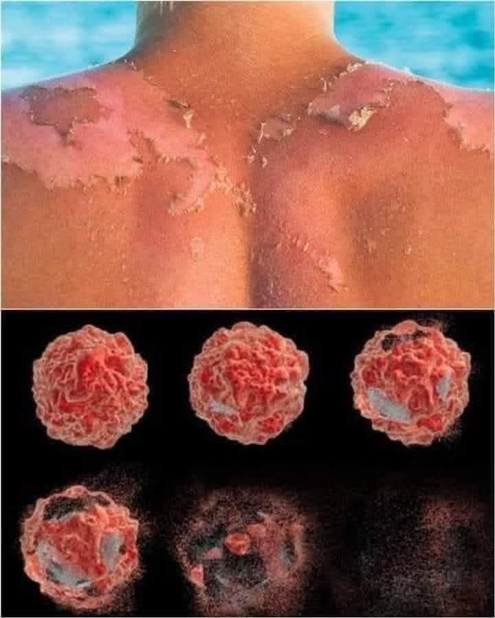 Үүнийг мэдэх үү?...
Наранд түлэгдэхэд арьсны эс чинь гэмтэж үхдэг биш, үнэндээ ДНХ нь гэмтэж, дараа нь эсүүд хорт хавдар болохгүйн тулд өөрийгөө үхүүлэхээр шийддэг. Энэ процессыг апоптоз гэж нэрлэдэг гэнэ.