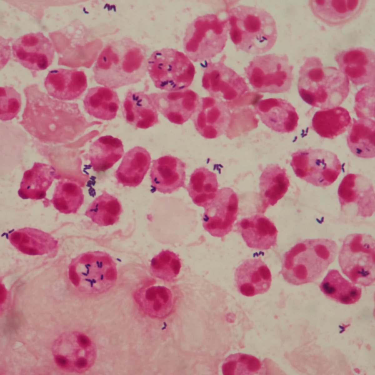 headbangerth's tweet photo. 喀痰のグラム染色
高齢者の肺炎（軽症）
Corynebacteriumが気道感染の原因となることは、グラム染色をやらない医師にはなかなか信じてもらえない。 https://t.co/A2gmCyZwno