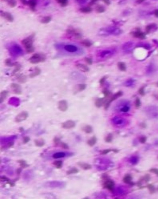 <a href="/DZenezan/">Dina Zenezan,MD</a> Yes it is. Looks like a keratinizing SqCC.