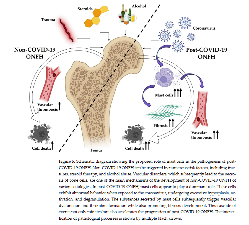 HarrySpoelstra's tweet image. Post-COVID-19 Femoral Head Osteonecrosis Exhibits Mast Cell Clusters, Fibrosis, and Vascular Thrombosis: Key Pathological Mechanisms in Long COVID-19 Bone Degeneration

🔥For many a new #LC presentation needing THR(Total Hip Replacement)😲

➡️&apos;Оsteonecrosis of the femoral head…