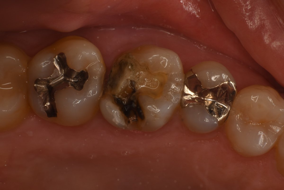 yuuta023's tweet image. 🦷2025/07/20
【日常の症例】

薄い機能咬頭を覆っていない場合、よく咬頭に亀裂が入っていたり、二次カリエスになっているのをみます

患者さんが予防行動を取れるようになっていて長期予後を考えるのであれば、しっかり咬頭を落とした方が形成しないよりも長く保つと思います…