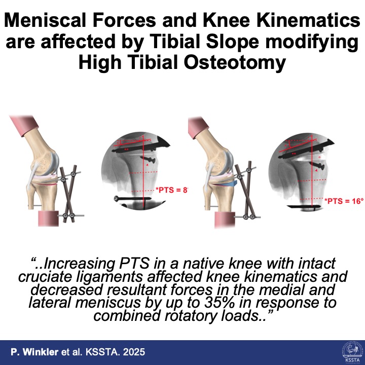Increasing posterior tibial slope alters knee kinematics but reduces meniscal forces under rotational loads — up to 35% reduction.
Implication: After HTO in cruciate-intact knees, higher PTS does not overload the meniscus.
New in KSSTA.

Reach here: doi.org/10.1002/ksa.12…