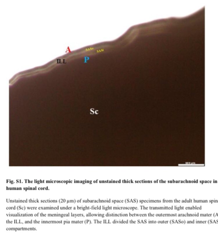 TSM_Humanist's tweet image. 4th Meningeal Layer:
—————————-
A non-peer reviewed study by Department of Anatomy, AIIMS, Patna, India demonstrate the presence of an ‘Intermediate Leptomeningeal Layer’ (ILL) in the human CNS along the entire neural axis, from the cortex to the caudal end of the spinal cord.