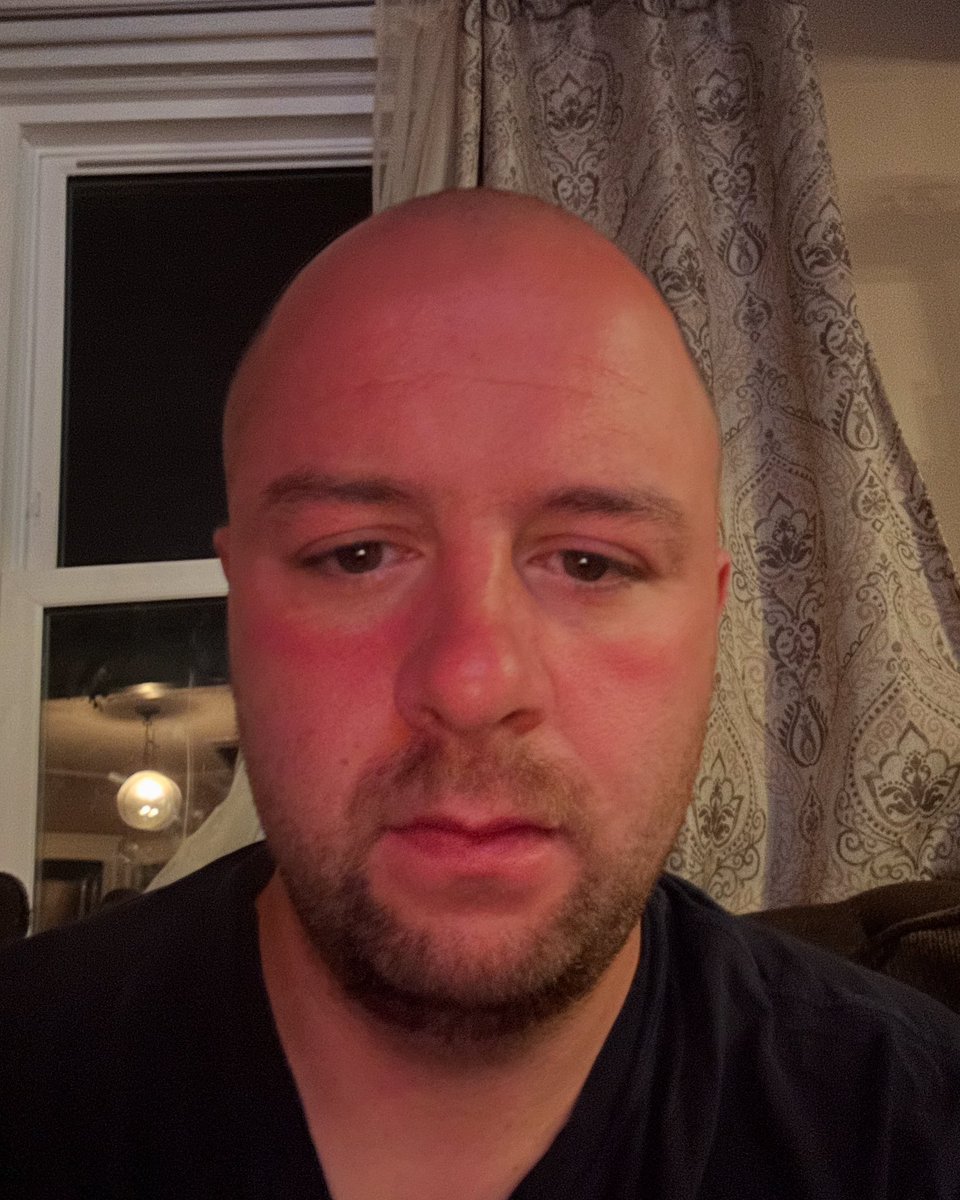 jamesrealmike's tweet photo. Caught wicked sunburn while out with family yesterday. One day I’ll learn.
#jamesmichels #sunburn #toomuchsun☀️ #sensitiveskin #familylife https://t.co/2gzoz8p76h
