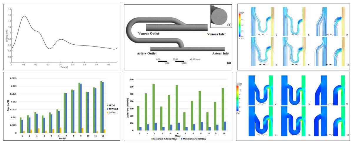 medntdj's tweet image. Effects of geometrical parameters on hemodynamics of arteriovenous graft: A 3D numerical simulation
sciencedirect.com/science/articl…
#Arteriovenous graft #Computational fluid dynamics #HemodialysisVascular access #Graft-vessel anastomosis #MedTwitter #scicomm #MedEd #AcademicTwitter