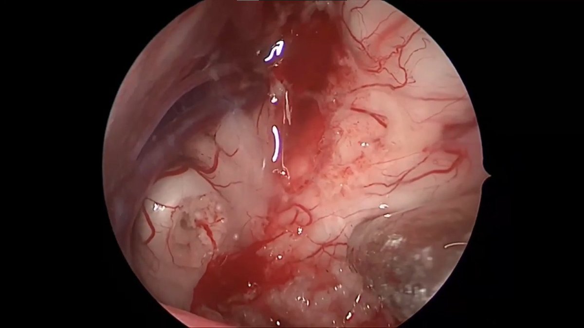 TheJNS's tweet image. #OperativeVideo Minimally invasive mastery: transorbital endoscopic excision of the paramedian epidermoid
thejns.org/video/view/jou…