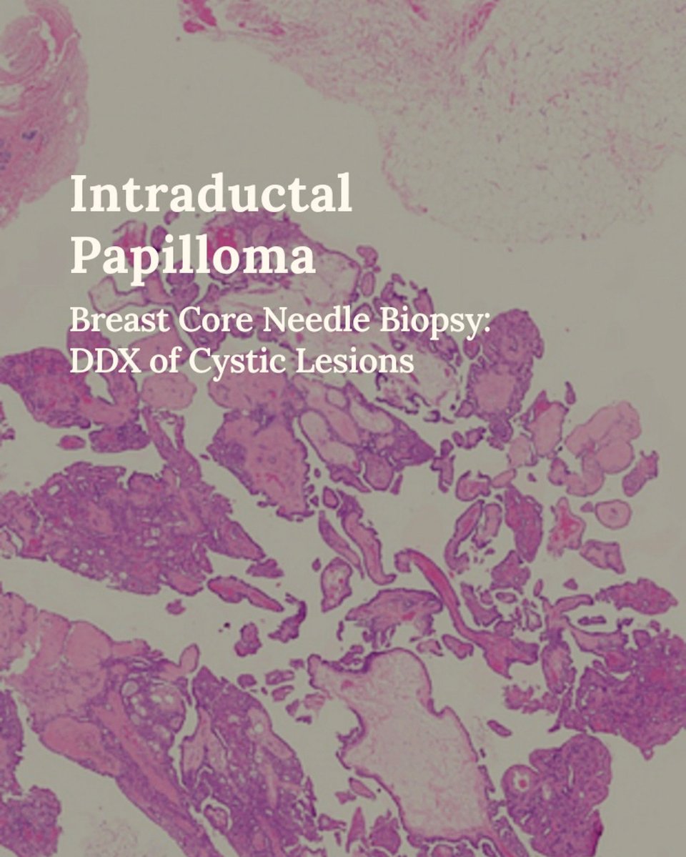 Intraductal papillomas, typically solid, can also present as fascinating cystic lesions.🔬 

thepathprincess.substack.com/p/intraductal-…

Pathologists must differentiate these benign cystic papillomas from more concerning lesions.

#BreastPathology #Pathology #PathTwitter #Pathologists