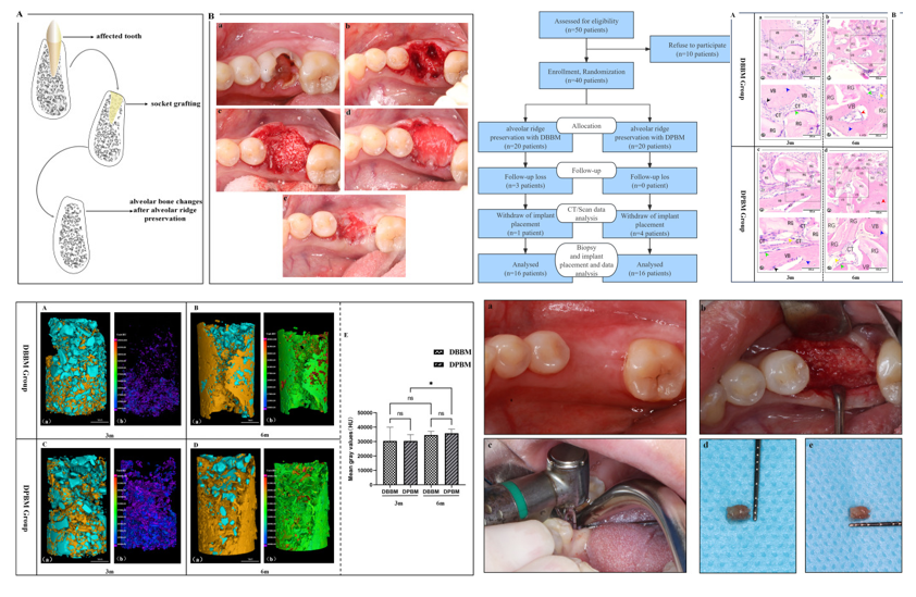 medntdj's tweet image. Micro-CT and histological evaluation of alveolar ridge preservation with Bio-Oss® and THE Graft®: A randomized controlled trial
sciencedirect.com/science/articl…
#Randomized clinical trial #Alveolar ridge preservation #Bone graftingHealing time #Histological analysis #Micro-CT analysis
