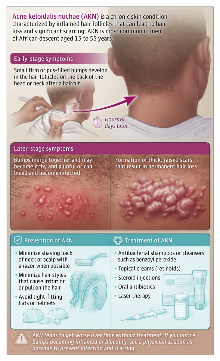 JAMADerm's tweet image. Most viewed this week from @JAMADerm:
This Patient Page describes the symptoms, diagnosis, and treatment of acne keloidalis nuchae.
ja.ma/4nX2I8I