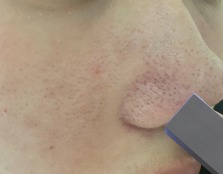 NoD5m's tweet image. ⬅️before       ➡️after
イソトレチノイン飲んだだけでこうなるのすごい。鼻の毛穴わかりやすいように鼻に指突っ込んで伸ばしてます。