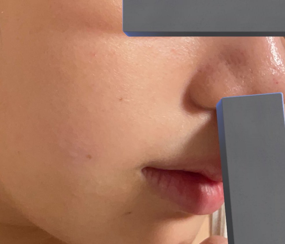 NoD5m's tweet image. ⬅️before       ➡️after
イソトレチノイン飲んだだけでこうなるのすごい。鼻の毛穴わかりやすいように鼻に指突っ込んで伸ばしてます。