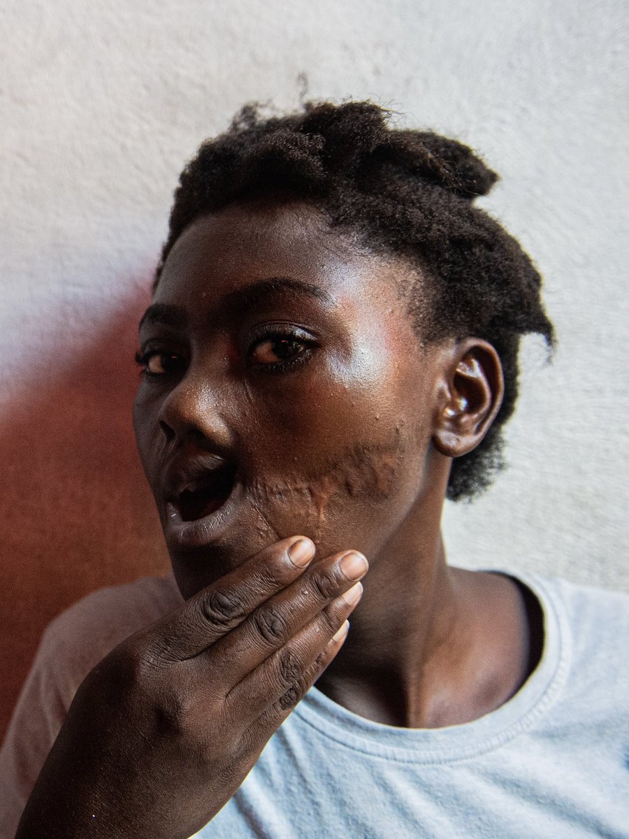 SiffroyC's tweet image. Lovely Jean Baptiste, 16, who was shot in the mouth by armed gangs, poses for a portrait, in Port-au-Prince, Haiti, on July 17, 2025.
More than 3,000 people have died amid escalating gang violence in Haiti since the beginning of the year, the United Nations said on July 11, 2025.