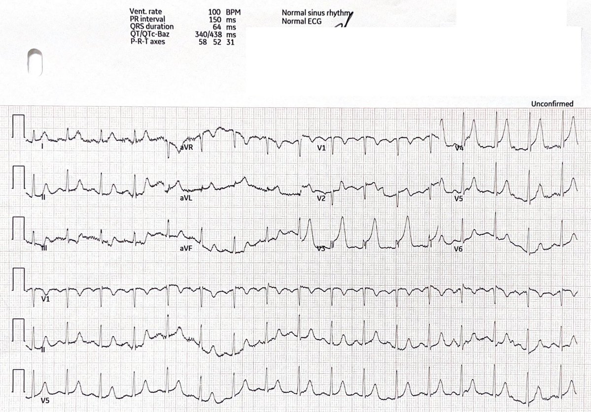 Another example of how we cannot trust a triage "normal ECG" interpretation. They ALL need to be seen by a qualified interpreter ASAP, despite what some articles have tried to suggest. [ECG courtesy Dr. Jason Lockette] #FOAMed