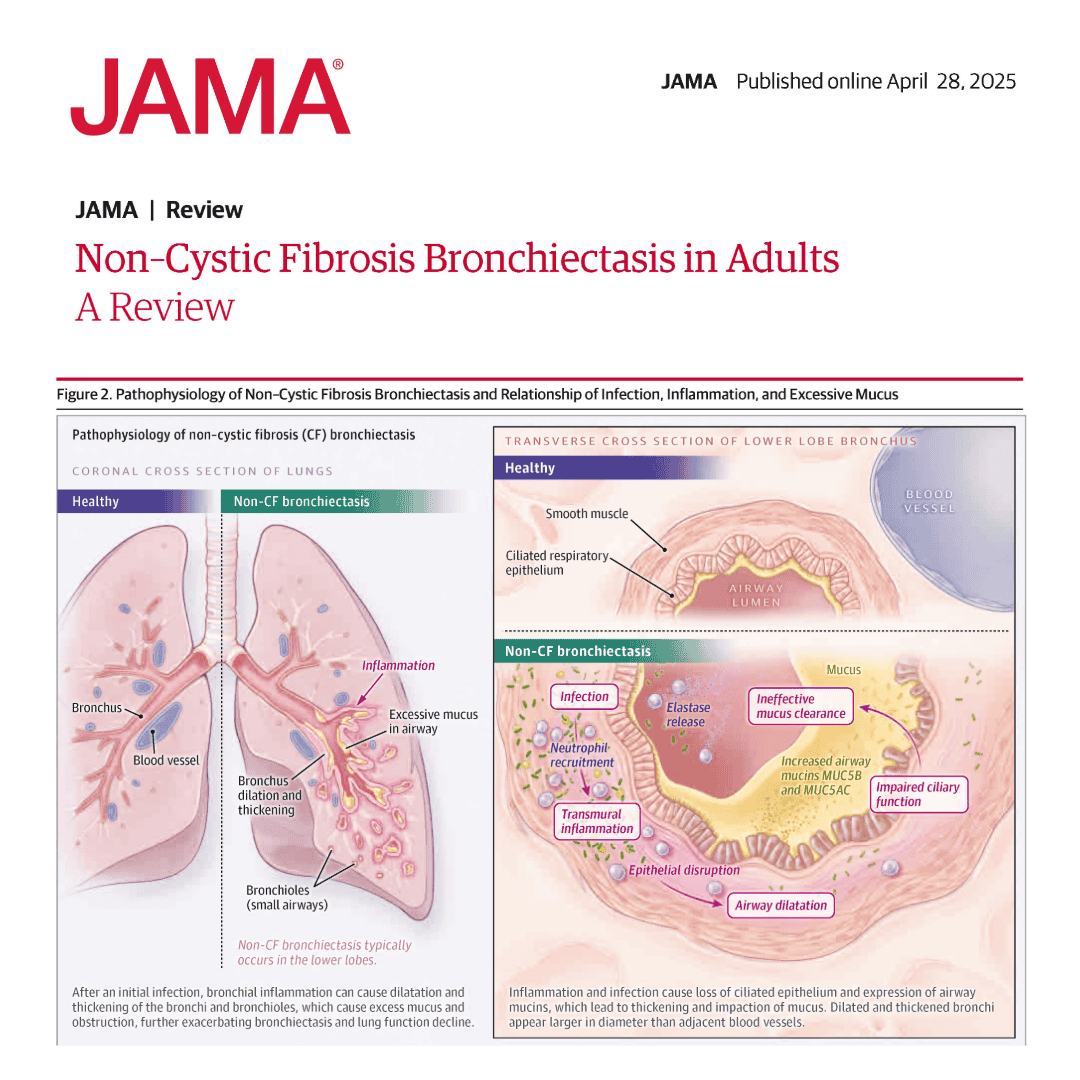 JAMA_current's tweet image. Non-cystic fibrosis (CF) bronchiectasis is a chronic lung condition that typically causes cough and sputum production.
Learn more in this Review.
ja.ma/4kJZOBi