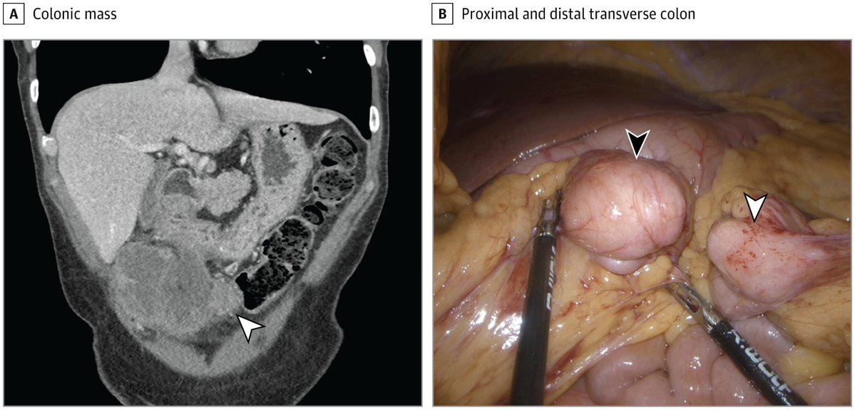JAMAOnc's tweet image. A woman in her 50s with a history of hemochromatosis, psoriasis, and type 2 diabetes presented with a 3-month history of abdominal pain, weight loss, and a large palpable fixed abdominal mass. What is your diagnosis? ja.ma/40XDPQc