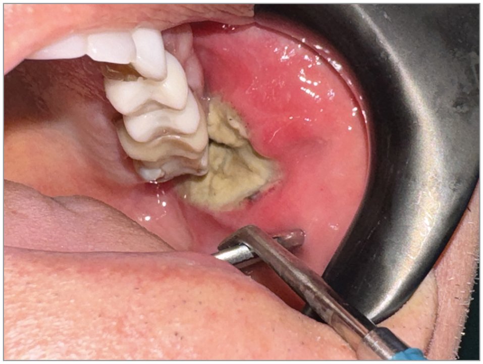 JAMAOto's tweet image. A healthy 69-year-old man with a painful, progressively enlarging ulcer located on the left buccal mucosa. What is your diagnosis? Take the Clinical Challenge. ja.ma/40RuIRa