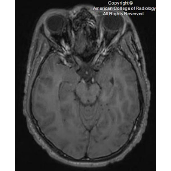 RadiologyACR's tweet image. A 16-year-boy presents with a 3-month history of progressive gait impairment with numbness and weakness of the extremities. #ACRCaseinPoint bit.ly/3HPvt6O