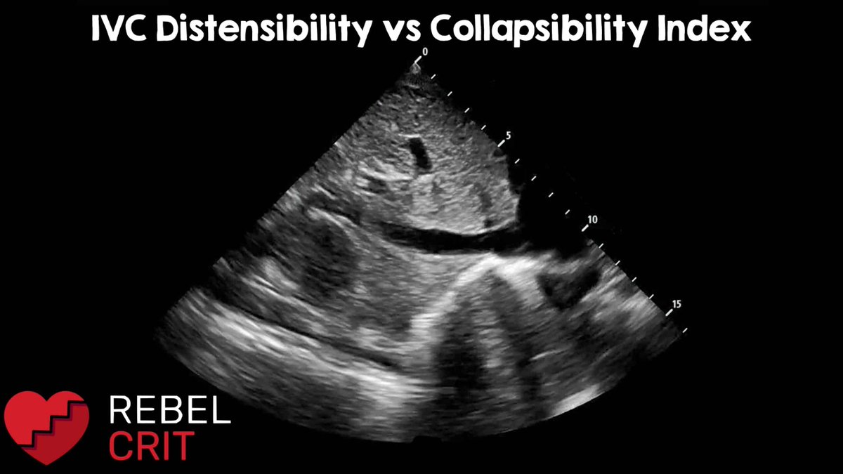 REBEL__EM's tweet image. 🚨 Are you using the wrong IVC index?
🫁 Spontaneous = Collapsibility Index (>42%)
💨 Ventilated = Distensibility Index (≥18%)
🔗 loom.ly/ShTQZuA
#EmergencyMedicine 🚑 #CriticalCare 🏥 #POCUS 🔍 #MedEd 📚
@marco_propersi @EMSwami @srrezaie @MRamzyDO