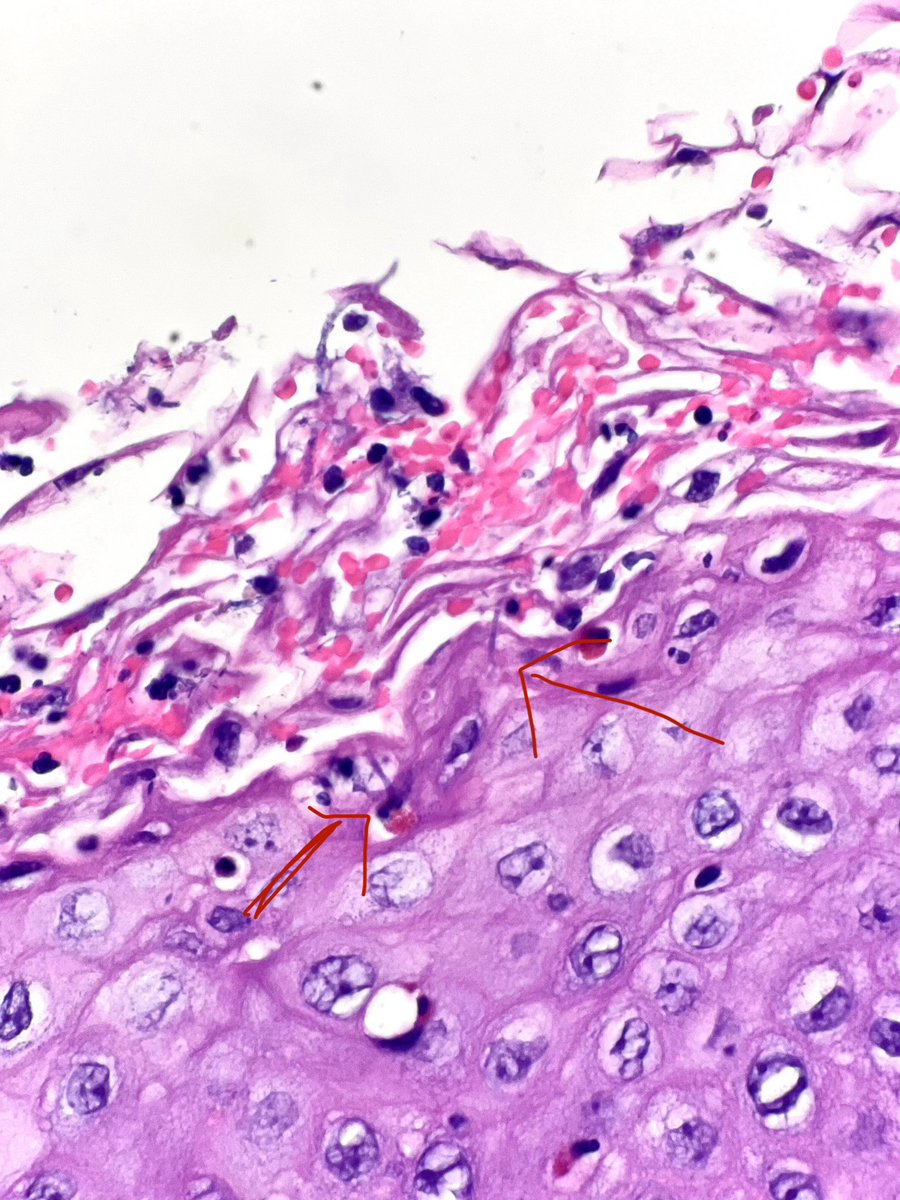 Fun tip for budding #pathologists! 
When you see “shredded 🥕 ” (or zucchini or your favorite 🥗) in an esophageal biopsy - take a closer look! 
Candida loves to lurk around the desquamated debris, often on surface but can be detached too #GIpath 
Specials in the next tweet
