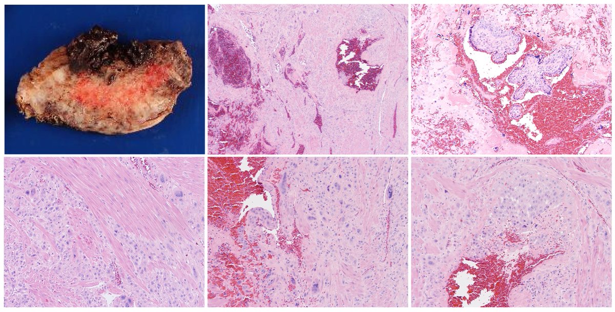 Pei Hui (@hui2pei) on Twitter photo Y-GTD Case of July 2025: 32-year-old woman with vaginal bleeding three weeks after evacuation of a second-trimester placenta underwent hysterectomy for placenta accreta. <a href="/yalepathology/">Yale Pathology</a> bit.ly/48Yq1pO Y-GTD Case of July 2025: 32-year-old woman with vaginal bleeding three weeks after evacuation of a second-trimester placenta underwent hysterectomy for placenta accreta. <a href="/yalepathology/">Yale Pathology</a> bit.ly/48Yq1pO