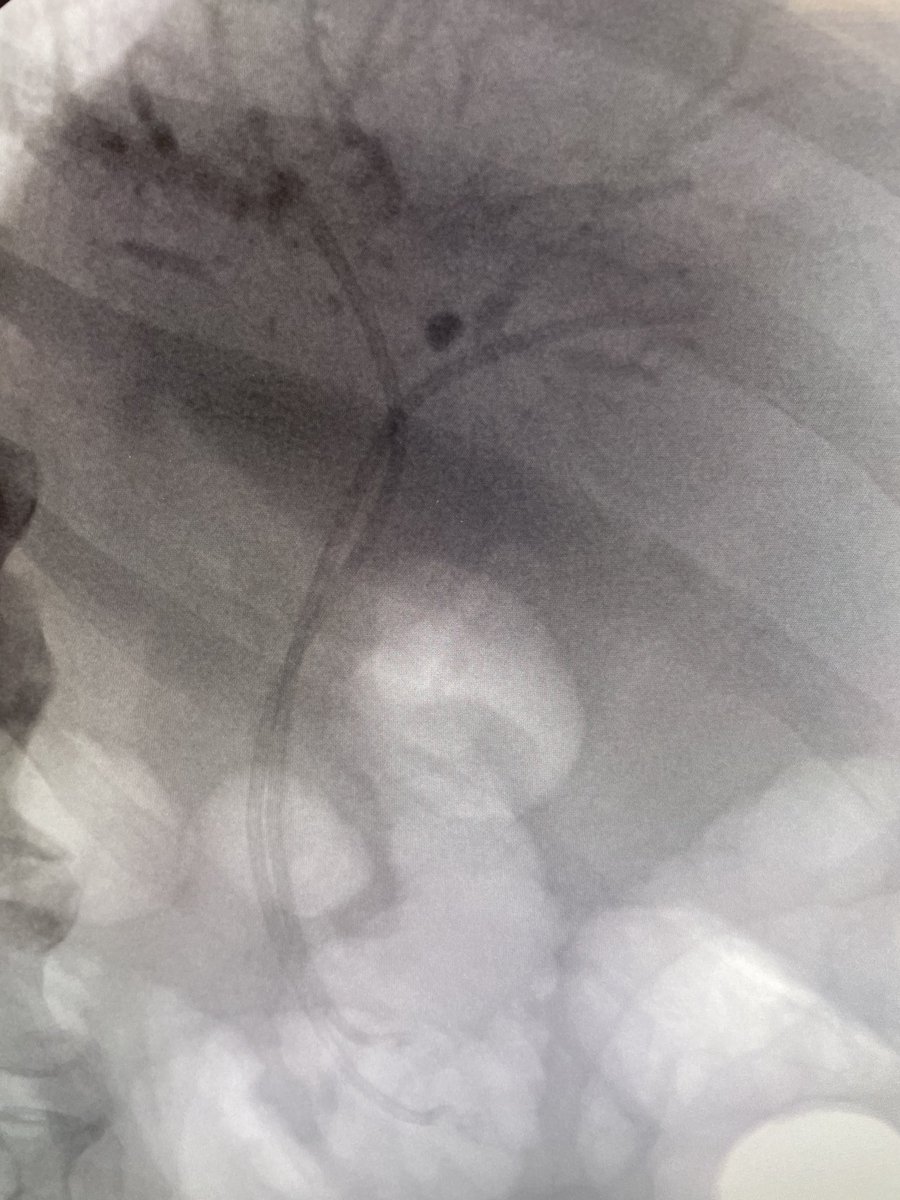 Saturday morning 7am hilar ERCP case. Bilateral stents with Spyglass. #gitwitter #ERCP <a href="/asge/">Aslak Gottlieb</a> ⁦<a href="/GIE_Journal/">GIE</a>⁩