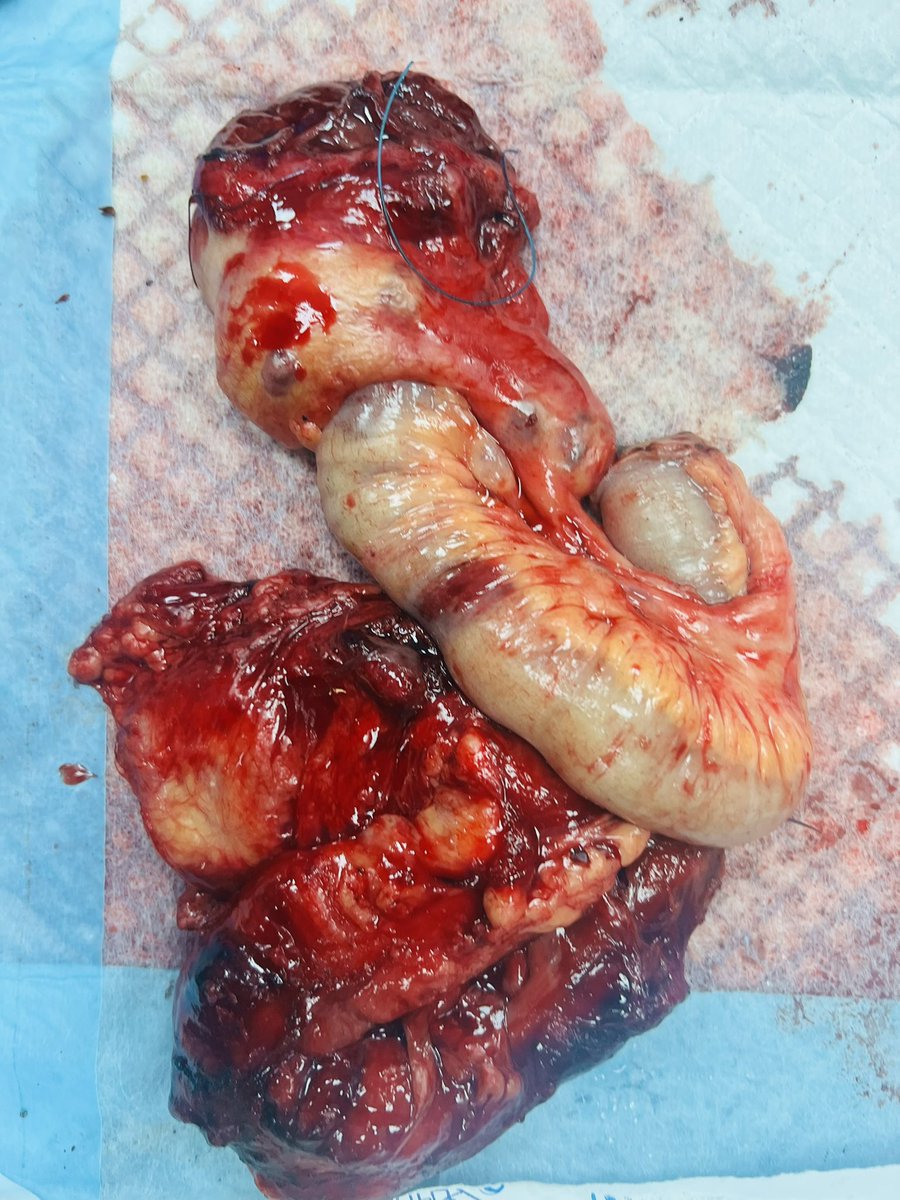 Fadibora3e's tweet image. Despite the hunger, we are still saving lives.
A patient arrived with his bowel outside his abdomen.
We rushed him to surgery and found a massive piece of shrapnel.
Half of his intestines had to be removed.
He’s now in the ICU, fighting to survive.
This is Gaza.
This is our…