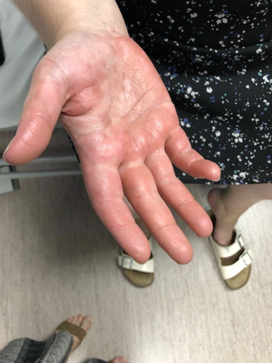 Janet Pope (@janetbirdope) on Twitter photo #ClinicalPearl
#Diagnosis in 2 #pictures
#immune #suppressed pt whose toddler is in daycare and had lesions in 
👇
#hand
#foot 
#mouth
🤔 You guessed it!
she swelled palms and soles 
Sloughed skin on feet 👣 #ClinicalPearl
#Diagnosis in 2 #pictures
#immune #suppressed pt whose toddler is in daycare and had lesions in 
👇
#hand
#foot 
#mouth
🤔 You guessed it!
she swelled palms and soles 
Sloughed skin on feet 👣