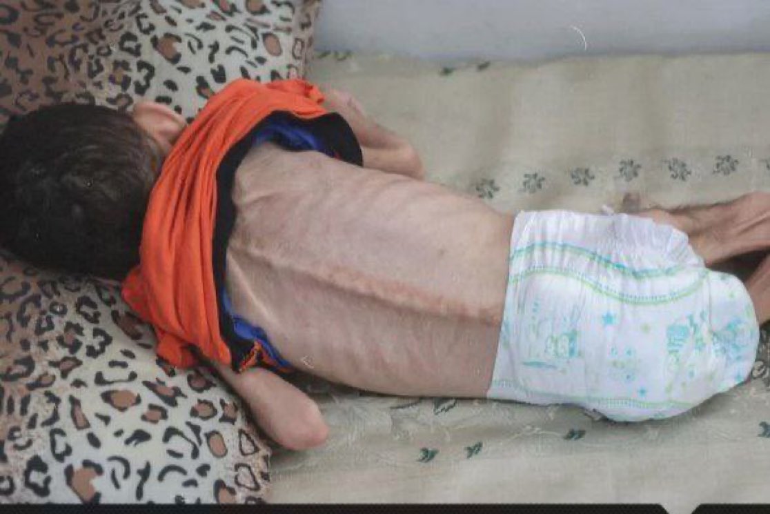 LinahAlsaafin's tweet image. This boy, Jawad Al-Anqar, died from starvation in Gaza City today, becoming the 70th child to die from hunger.
يلعن جيرتك يا مصر