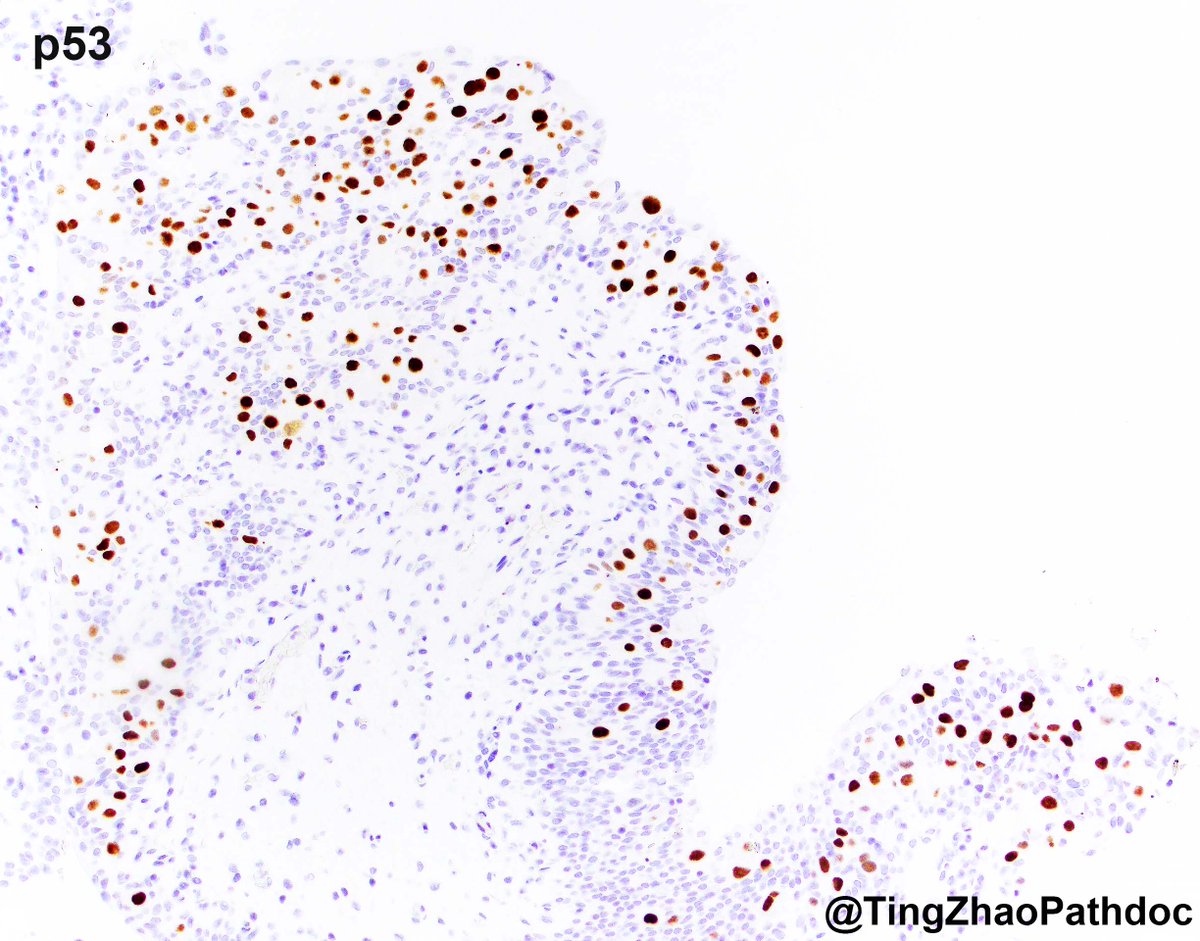 Ting Zhao, MD (@tingzhaopathdoc) on Twitter photo <a href="/MGBpathology/">Mass General Brigham Pathology</a> <a href="/MGHPathology/">MGH Pathology</a> Urothelial carcinoma in situ (UCIS) with plasmacytoid features #GUpath
➡️UCIS with cellular rounding, enlarged eccentric nuclei, and dense eosinophilic cytoplasm
➡️Diffuse/strong CK20 in ~95%, mutant p53 (overexpression or null) in ~35%, absence of CD44 reactivity in the <a href="/MGBpathology/">Mass General Brigham Pathology</a> <a href="/MGHPathology/">MGH Pathology</a> Urothelial carcinoma in situ (UCIS) with plasmacytoid features #GUpath
➡️UCIS with cellular rounding, enlarged eccentric nuclei, and dense eosinophilic cytoplasm
➡️Diffuse/strong CK20 in ~95%, mutant p53 (overexpression or null) in ~35%, absence of CD44 reactivity in the