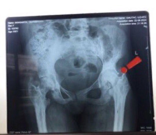 RedbowWarrior's tweet image. Im writing this with a heavy heart. I don’t want to die. Depression is slowing taking over me. I’m struggling &need all the possible help I can get right now. I’m having Avascular necrosis &d pain is unbearable. My hip head is totally lost &is piercing my cervix. This disease—-