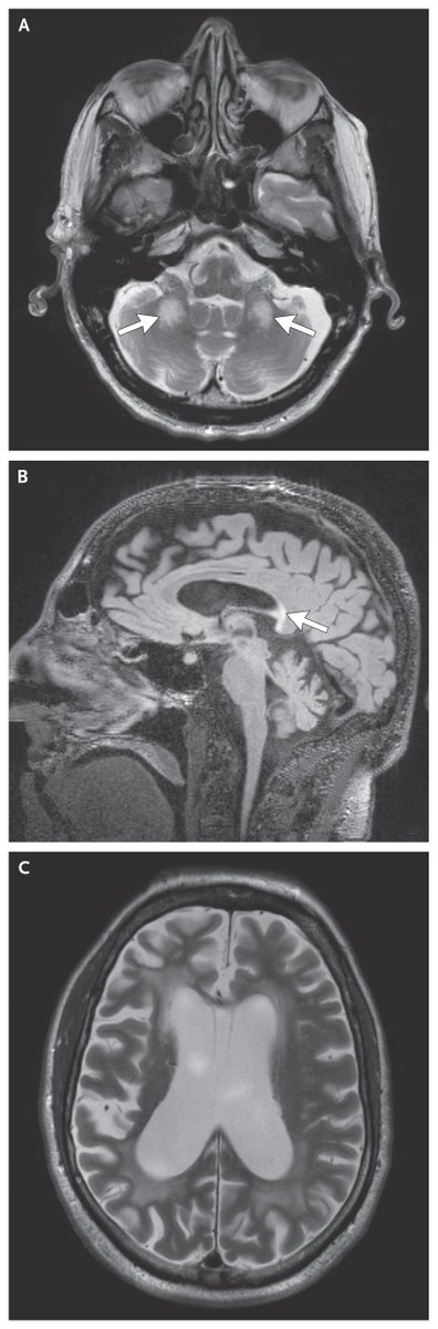 NEJM (@nejm) on Twitter photo š§¬ šš²š®šššæš²š š¼š³ ššæš®š“š¶š¹š² š«āšššš¼š°š¶š®šš²š± š§šæš²šŗš¼šæāššš®š
š¶š® š¦šš»š±šæš¼šŗš² š¼š» š š„š
Shown are a T2-weighted MRI scan of the middle cerebellar peduncle with signal change (Panel A, arrow; axial view), signal change in the splenium of the corpus š§¬ šš²š®šššæš²š š¼š³ ššæš®š“š¶š¹š² š«āšššš¼š°š¶š®šš²š± š§šæš²šŗš¼šæāššš®š
š¶š® š¦šš»š±šæš¼šŗš² š¼š» š š„š
Shown are a T2-weighted MRI scan of the middle cerebellar peduncle with signal change (Panel A, arrow; axial view), signal change in the splenium of the corpus