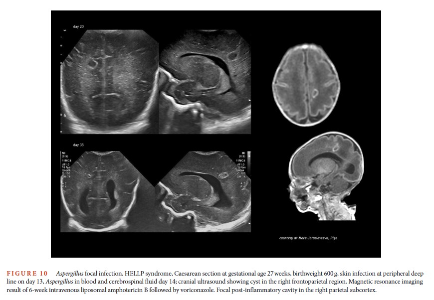 JordiRoldanB's tweet image. Do you routinely use cranial ultrasound?
We do — and for good reason.
As a screening and monitoring tool, it's incredibly effective in selected neonatal cases.
This paper is worth reading — findings can be trickier than they seem 🧠📖
#PedsRad
🟢🔓pmc.ncbi.nlm.nih.gov/articles/PMC12…