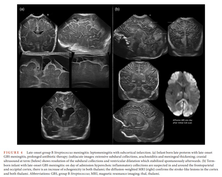 JordiRoldanB's tweet image. Do you routinely use cranial ultrasound?
We do — and for good reason.
As a screening and monitoring tool, it's incredibly effective in selected neonatal cases.
This paper is worth reading — findings can be trickier than they seem 🧠📖
#PedsRad
🟢🔓pmc.ncbi.nlm.nih.gov/articles/PMC12…