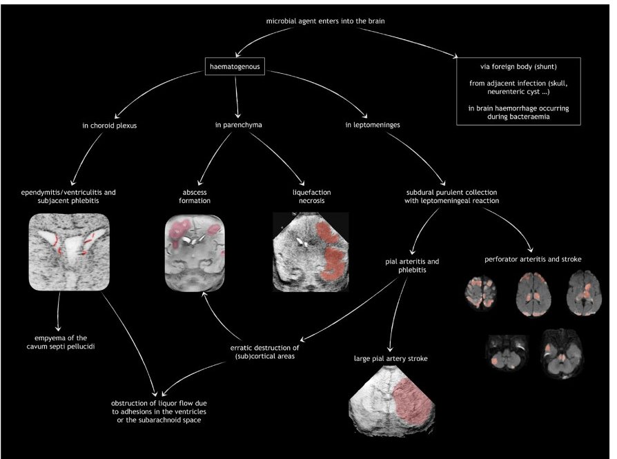 JordiRoldanB's tweet image. Do you routinely use cranial ultrasound?
We do — and for good reason.
As a screening and monitoring tool, it's incredibly effective in selected neonatal cases.
This paper is worth reading — findings can be trickier than they seem 🧠📖
#PedsRad
🟢🔓pmc.ncbi.nlm.nih.gov/articles/PMC12…