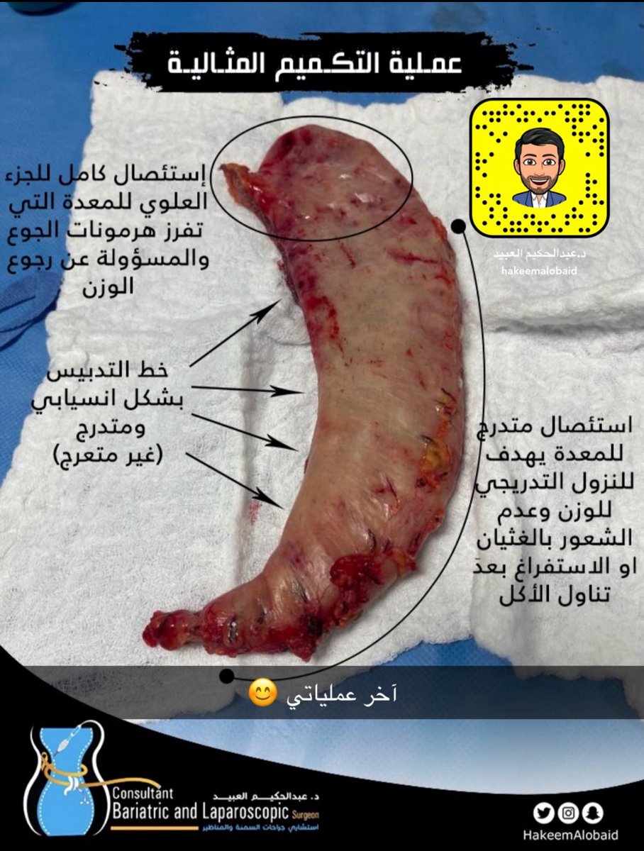 د.عبدالحكيم العبيد MD, MSc, FRCSC🇸🇦 tweet media