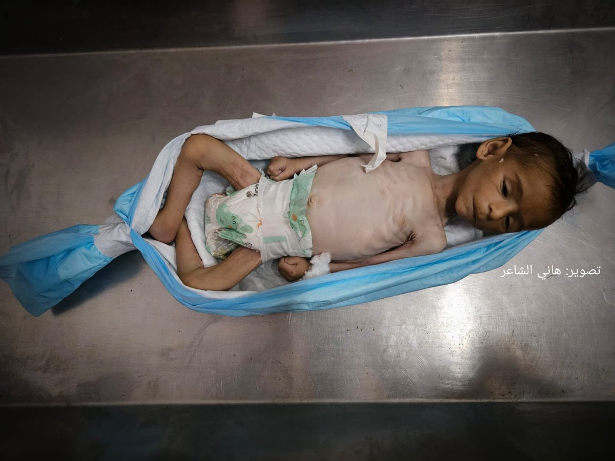 RamAbdu's tweet image. Nasser Medical Complex: Child Yahya Al-Najjar from Khan Younis has died due to Israeli-induced starvation and severe malnutrition.