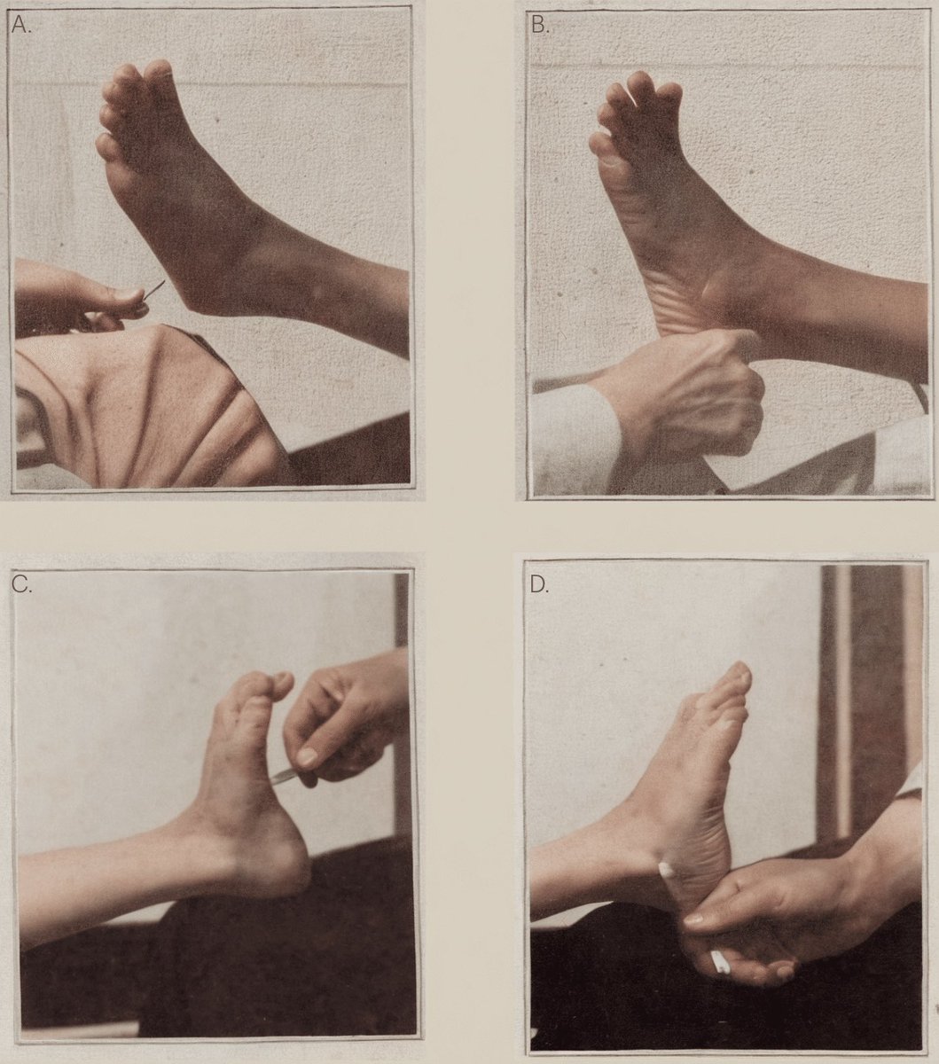 alb_giraldo's tweet photo. In May 1911, American neurologist and psychiatrist Charles Gilbert #Chaddock (1861–1936), translator and admirer of the work of Joseph #Babiński, presented at the St. Louis Neurological Society the preliminary communication of his modification of the Babiński sign. Chaddock described that stimulation of the lateral surface of the foot (S1 dermatome) could also induce dorsiflexion of the hallux and fanning of the other toes in patients with pyramidal tract lesions. The most sensitive area for eliciting his external ankle sign as overlying a slight depression just in front of the lowest point of the external malleolus and behind the tuberosity of the cuboid.
He believed his sign to have the significant advantage of minimising dorsiflexion of the foot as a withdrawal reaction to noxious stimulation: “I have found the extension of one or more or all of the toes with or without fanning of them when the external inframalleolar skin is irritated in cases of organic disease is a spinal cortical reflex path. I shall call it the ‘external malleolar sign’ external malleolar sign.”
A study published in 2015 that compared the Babiński, Chaddock, and Oppenheim reflexes found that the Babiński was of higher sensitivity, and that the Babiński and the Chaddock demonstrated similar positive predictive values (70.3% and 66.5%, respectively). Like the Babiński reflex, the Chaddock reflex may also be positive in healthy babies until 2 years old because infants have an incompletely myelinated corticospinal tract.
Chaddock was a very interesting and versatile personality beyond his contributions to medicine; he was an accomplished linguist, who translated Horace from Latin as capably as he did Babiński from French and Krafft-Ebing from German, and also a poet and litterateur.
📸 Charles Gilbert Chaddock as he appeared at the time of his work upon the external ankle sign. Drawn by W. H. French from a 1906 snapshot and a 1912 photograph.
📸 26 year old patient with left hemiparesis. A. Babiński positive (left) B. Chaddock sign positive (left). C Babiński negative (right) D. Chaddock negative (right). From: Chaddock CG. A preliminary consideration concerning a new diagnostic nervous sign. Interstate Med J 1911; 12: 742–746. https://t.co/enexzV0wVo