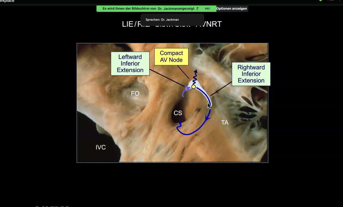 EPWaveDoc's tweet image. #Epeeps #CardioTwitter Today I have listened a second time to Warren Sonny Jackman’s #AVNRT webinar. And again I have found new information and inspiration. #ResettingTechnique #InEPSizeDoesNotMatter. Thank you, Sonny!