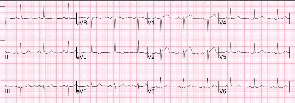 smithECGBlog's tweet image. chest pain in a 40-something woman.
drsmithsecgblog.com/even-omi-that-…