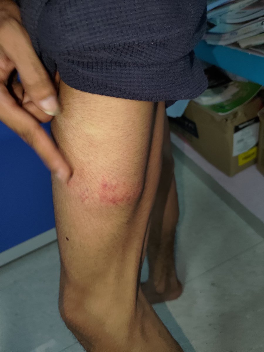 313Mahato's tweet photo. @BiharGRP @IRCTCofficial @RailwaySeva @RailMinIndia @PMOIndia GRP officers took me to the GRP LOCKUP, deleted video evidence from my phone, &amp; threatened false charges. Sheikhpura stn refused refund. Attaching medical proof &amp; injury photos. Strict action needed! #AhaanPanday https://t.co/UqVZnKkjBM