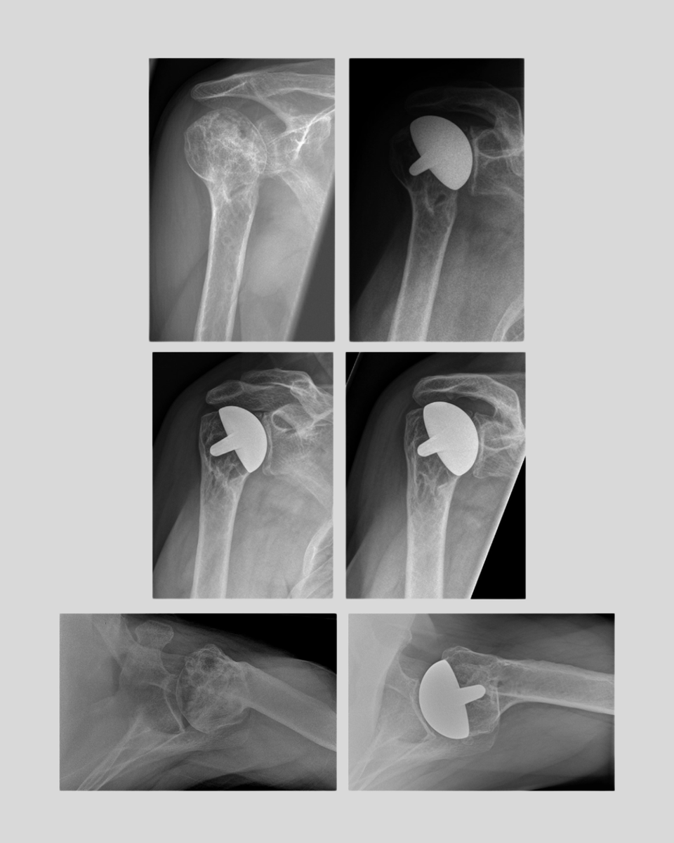 BoneJointJ's tweet image. Stemless humeral head arthroplasty offers a bone-preserving option that yields good long-term pain relief and function in younger patients.
#Arthroplasty #Shoulder #Orthopedics #BJJ
ow.ly/USSE50WkgYf