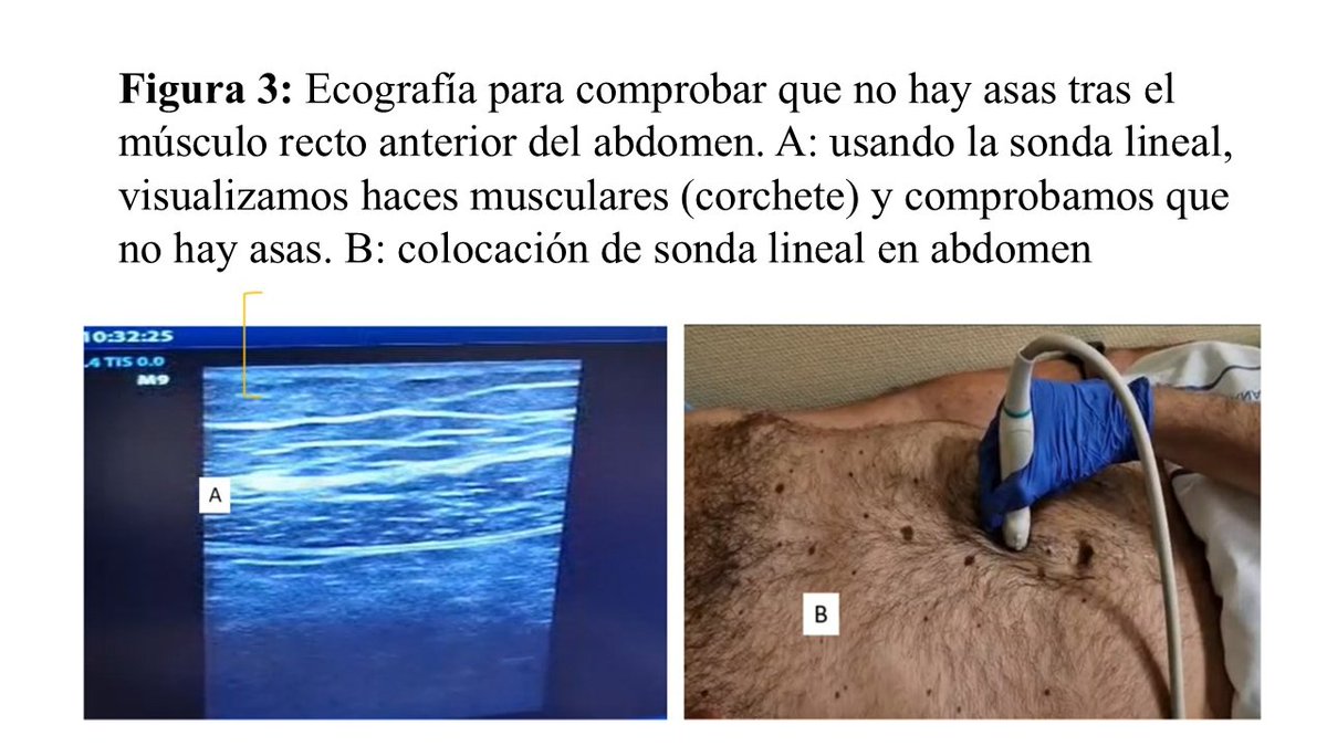 Avel con V chica 🥸 (@avelromanneph) on Twitter photo Implantación Catéter Peritoneal: Técnica percutánea por Grupo NDI de la <a href="/SENefrologia/">S.E.N. Nefrología</a>
-1ra localización izq porq? para mantener lado derecho para TR
-A. Epigástrica suele estar 5 cm línea alba
nefrologiaaldia.org/es-articulo-im… Implantación Catéter Peritoneal: Técnica percutánea por Grupo NDI de la <a href="/SENefrologia/">S.E.N. Nefrología</a>
-1ra localización izq porq? para mantener lado derecho para TR
-A. Epigástrica suele estar 5 cm línea alba
nefrologiaaldia.org/es-articulo-im…