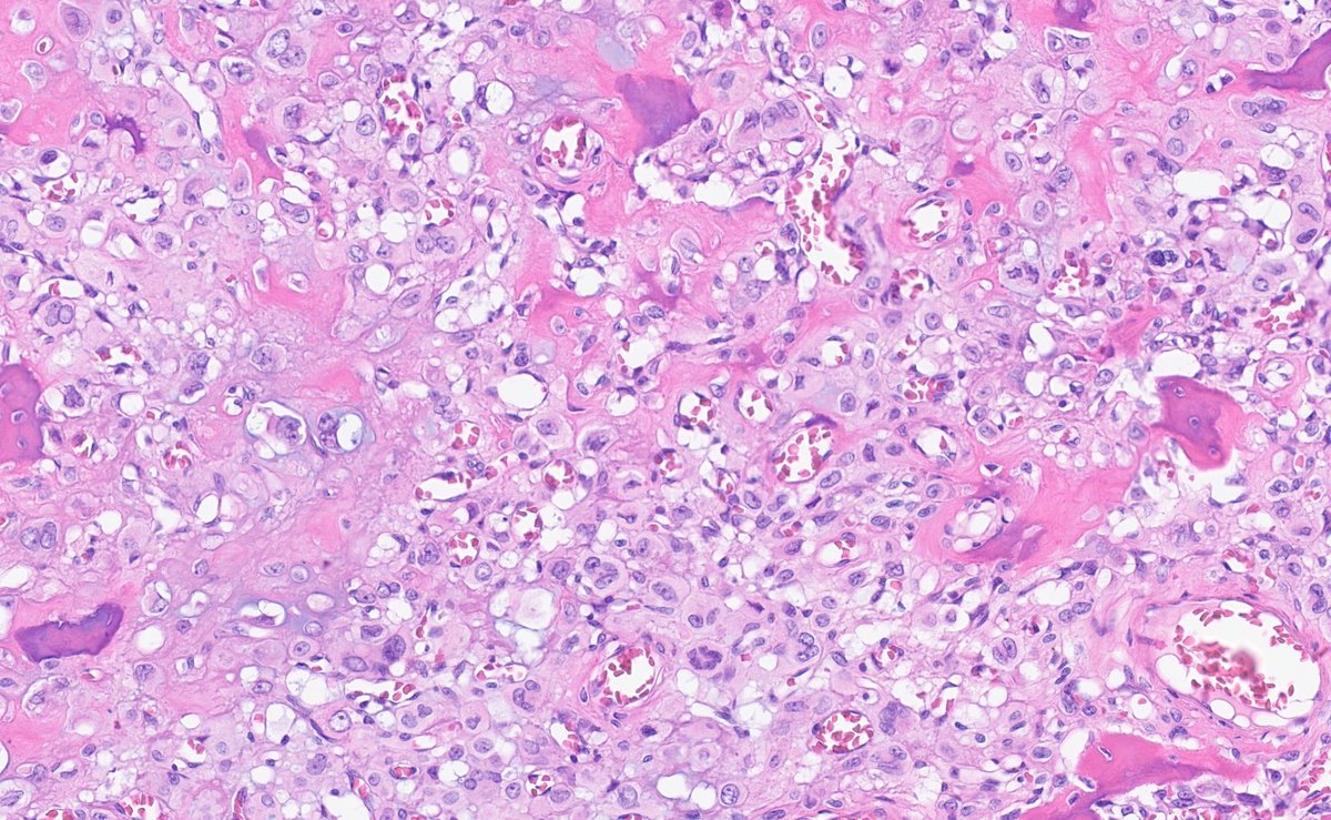 Beautiful  case of Clear cell chondrosarcoma. Note the round to polygonal cells with abundant eosinophilic to clear cytoplasm, and trabeculae of woven bone. #ISBSTP #BST