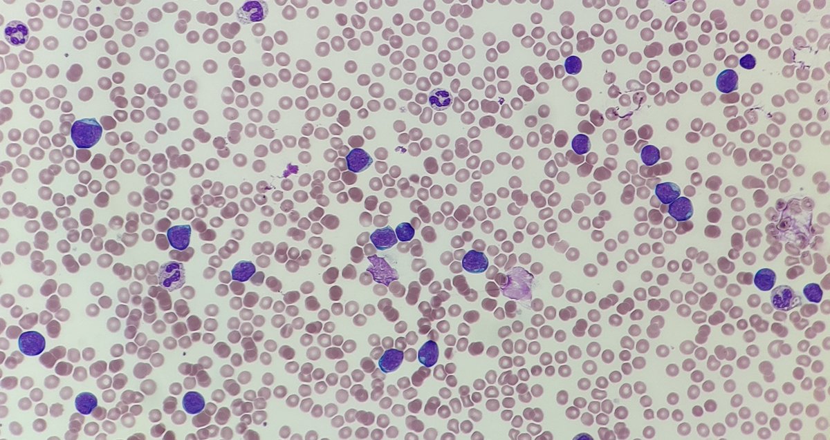 🩸#MorphologyMonday | Case MM250721

onlycells.co.uk/mm250721/

This week’s case comes from a 14 year old teen with a total white cell count of 81.25 ×10⁹/L, low platelets, and an abnormal FBC.

Blood film images attached. What would you be considering based on this FBC and the