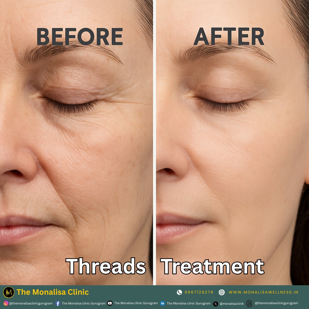 monalisaclinik's tweet image. ✨ Witness the Transformation! ✨
⁠
📍 Monalisa Clinic, Gurugram
📞 9667129276
🌐 monalisaclinic.com
⁠
#ThreadsLift #SkinTightening #AntiAgingTreatment #MonalisaClinic #GurugramSkincare #BeforeAndAfter #FacialThreads #YouthfulSkin #NonSurgicalLift #SkinGlow #PDOThreads