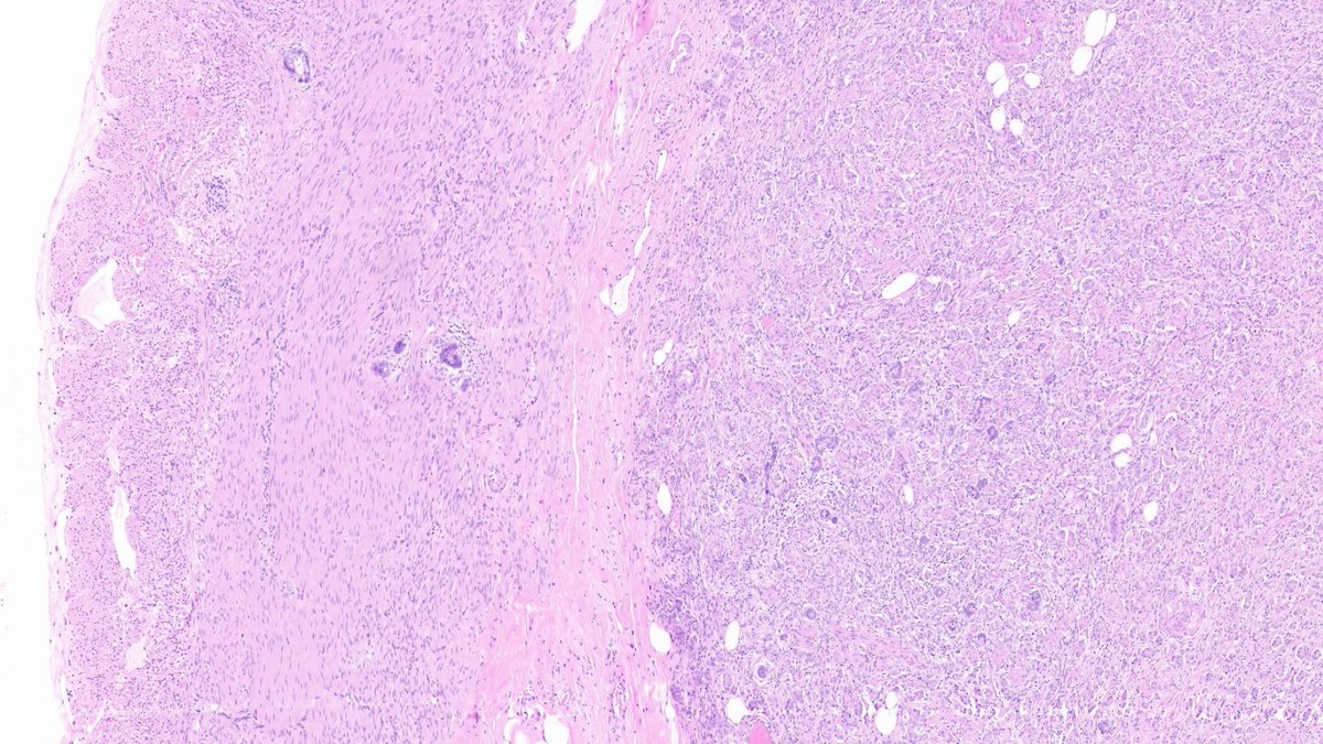 Hi #pathtwitter

Sorry I have been absent, but I have moved jobs!

I am now working in Perth, Australia for Pathwest and (soon for) <a href="/uwanews/">UWA</a> (as A/Prof).

Will get back to posting soon, in the meantime, here is an interesting colleague's case.

#GIpath #Endopath #Pathresidents